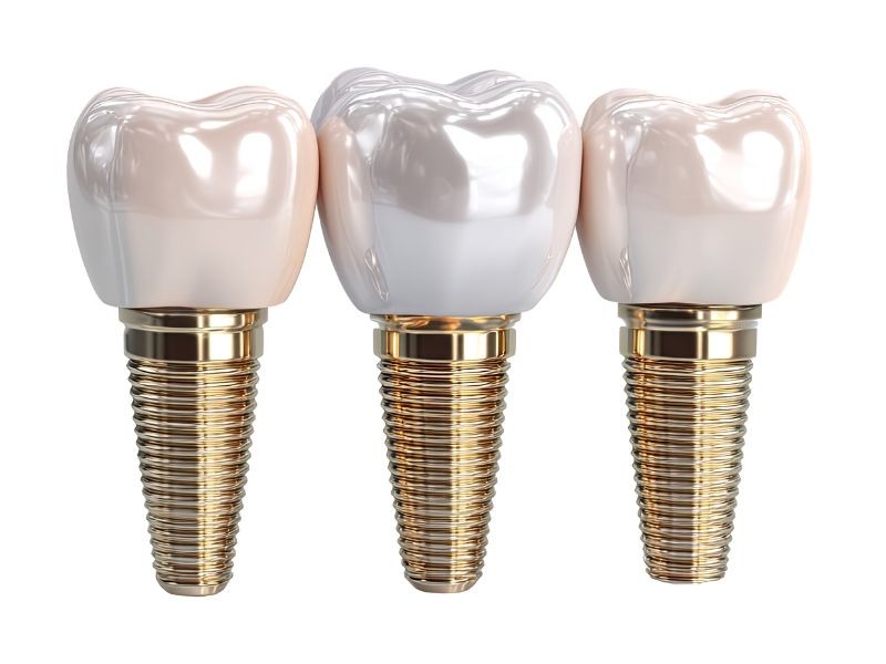 Prótese em Sessão Única em Campinas SP: O que É, Como Funciona e Quem Pode Fazer