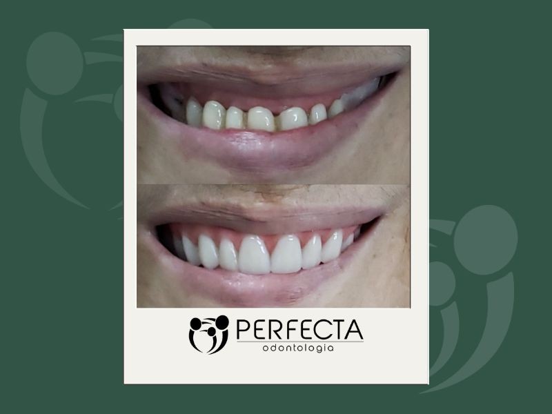 A Prótese Protocolo é Fixa ou Ela Sai? Descubra Como Funciona