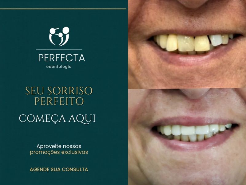 Implante de Carga Imediata: Saia do Consultório com o Sorriso Novo no Mesmo Dia