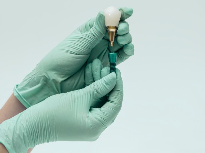 Implante Dentário: 15 Perguntas que Todo Paciente Quer Saber