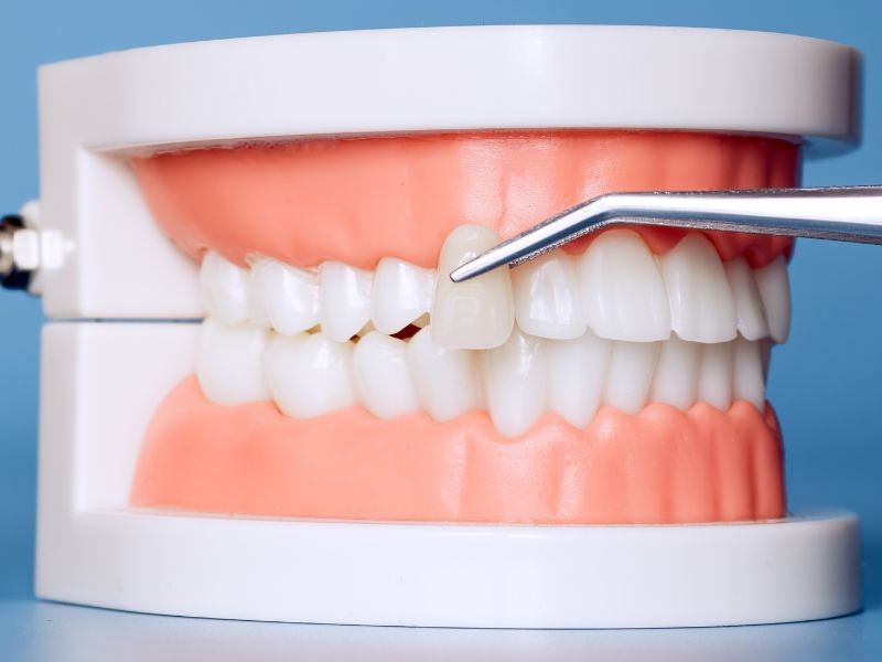 Facetas Dentais com Desgaste Mínimo: O que São e Por que Preservam Seu Dente Natural