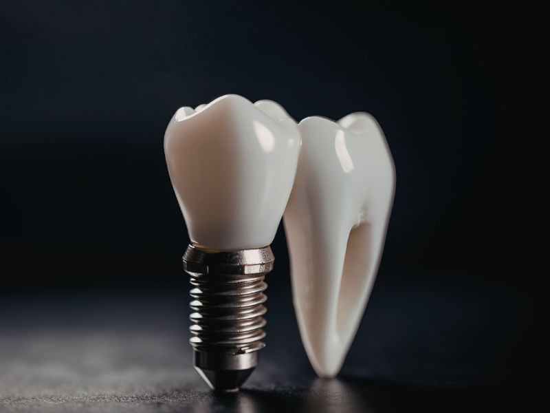 Implante de Carga Imediata: O que É e Como Sair do Consultório com o Dente no Mesmo Dia