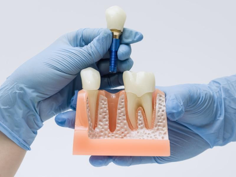 Enxerto Ósseo para Implantes