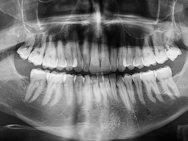 Raio-X Panorâmico Digital