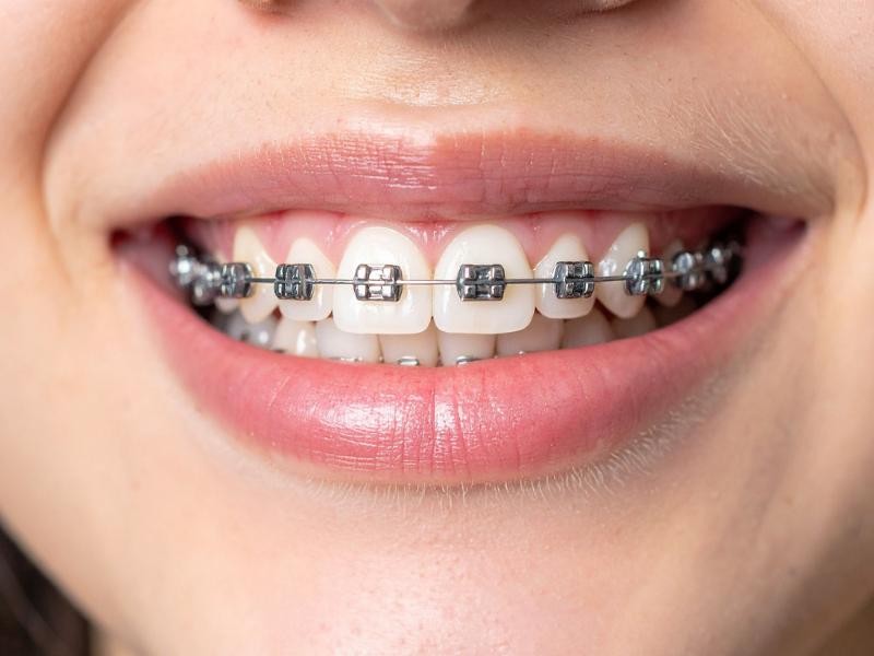 Tratamento Ortodôntico